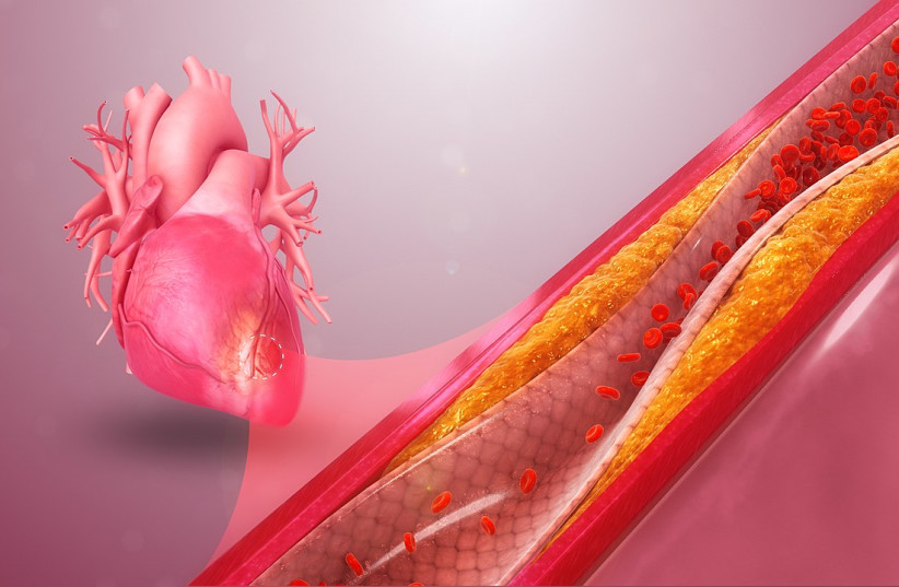  3D medical animation still showing reduced blood flow in preventing the heart muscle from receiving enough oxygen. (credit: Wikimedia Commons)