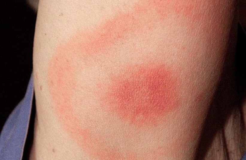  This 2007 photograph depicts the pathognomonic erythematous rash in the pattern of a “bull’s-eye”, which manifested at the site of a tick bite on this Maryland woman’s posterior right upper arm, who’d subsequently contracted Lyme disease. (credit: James Gathany/Wikimedia)