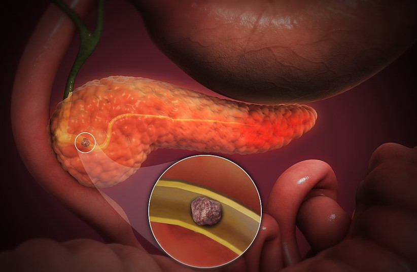  3D Medical Animation still shot of pancreas showing acute pancreatitis. (credit: Wikimedia Commons)