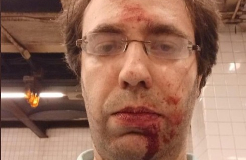  Fima Zlatsin following his assault on a New York City subway. (photo credit: Fima Zlatsin/via Dov Hikind)