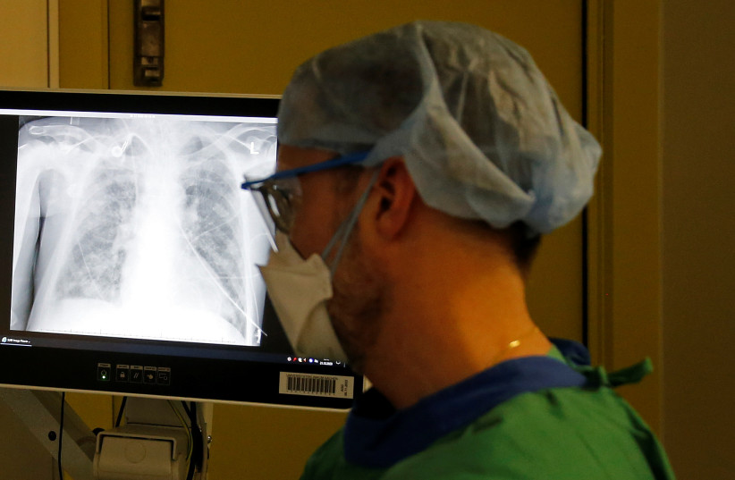 AI-based tool for lung cancer treatment developed in Jerusalem - Vimarsana News