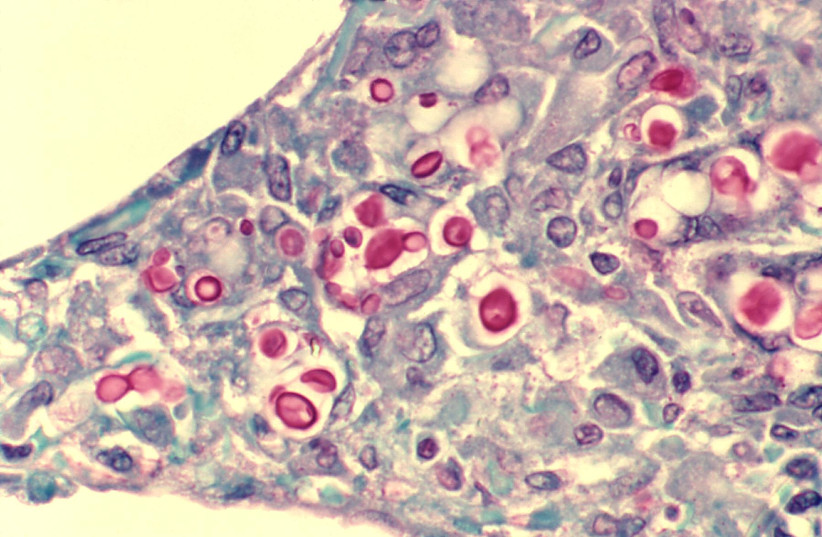 Cryptococcosis of lung in patient with AIDS. (photo credit: CDC/DR. EDWIN P. EWING, JR./PUBLIC DOMAIN/VIA WIKIMEDIA COMMONS)