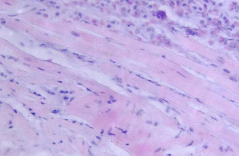 Endomyocardial biopsy specimen. Extensive eosinophilic infiltrate involving the endocardium and myocardium (hematoxylin and eosin). (photo credit: KURT DEB, BEHRUS DJAVIDANI, ET AL./CC BY 2.0 (HTTPS://CREATIVECOMMONS.ORG/LICENSES/BY/2.0)/WIKIMEDIA)