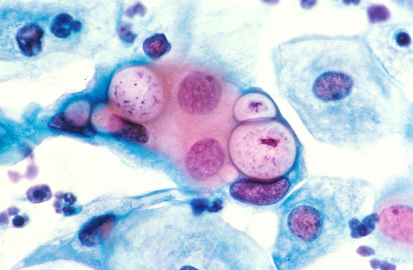 Human pap smear showing clamydia in the vacuoles at 500x and stained with H&E. (photo credit: Wikimedia Commons)