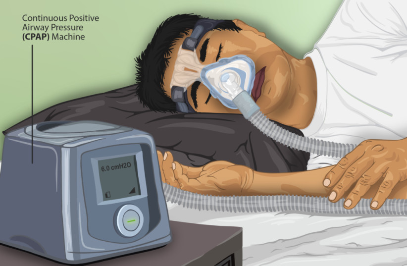  A sleep apnea patient using a continuous positive airway pressure (CPAP) machine while sleeping (Illustrative). (credit: Wikimedia Commons)