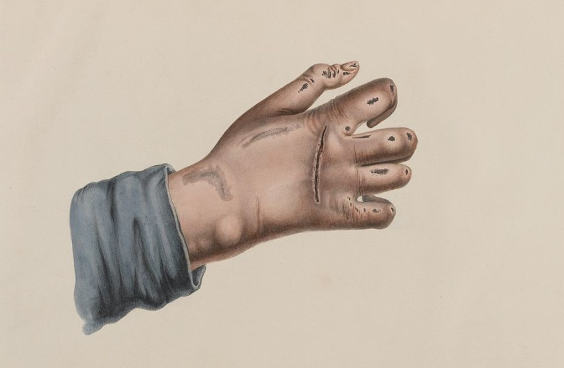  Hand showing leprosy (Illustrative). (photo credit: Wikimedia Commons)