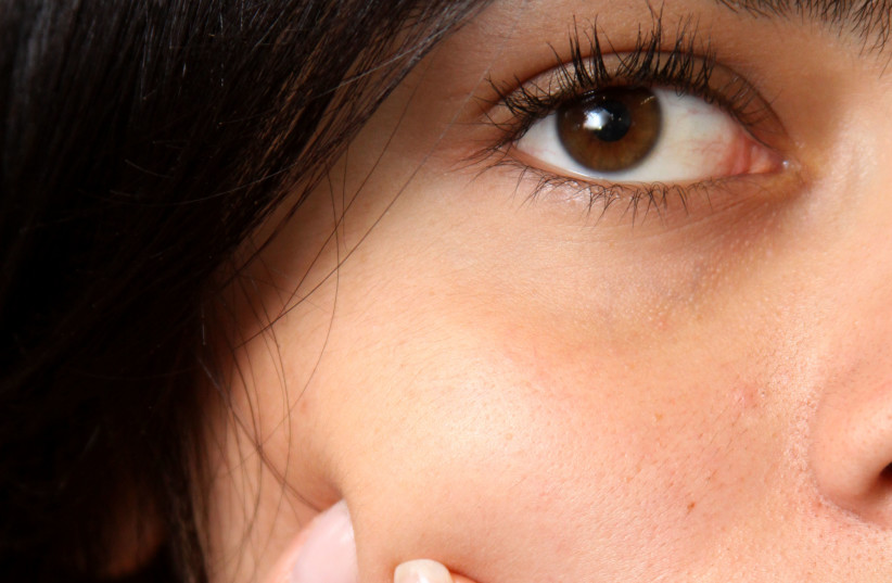 Will this acne drug cause depression? Study says not - Vimarsana News