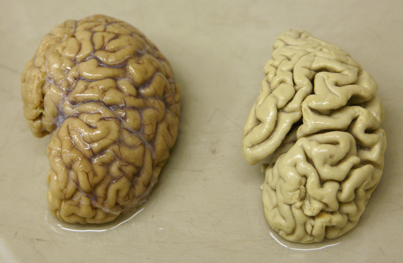  One hemisphere of a healthy brain (L) is pictured next to one hemisphere of a brain of a person suffering from Alzheimer disease, at the Morphological unit of psychopathology in the Neuropsychiatry division of the Belle Idee University Hospital in Chene-Bourg near Geneva March 14, 2011. (credit: DENIS BALIBOUSE/REUTERS)
