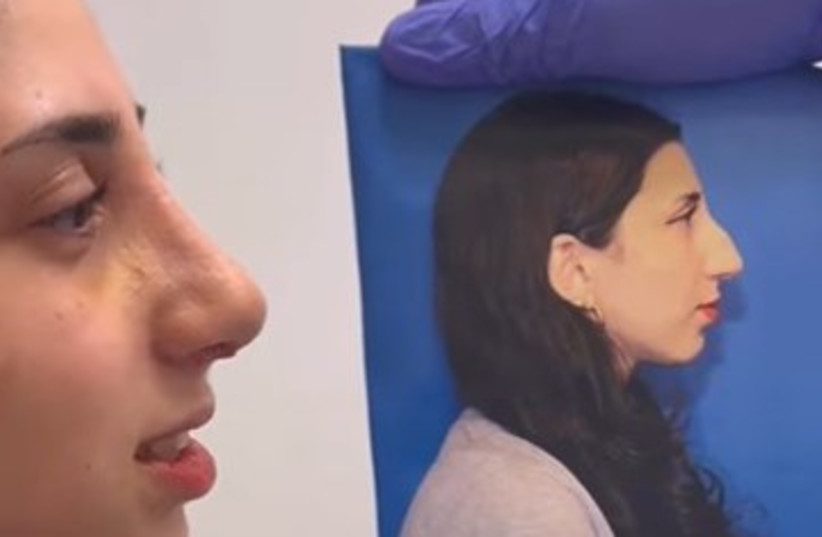 Woman seeing a before and after picture of a nose job (credit: Dr. Ira Savetsky)