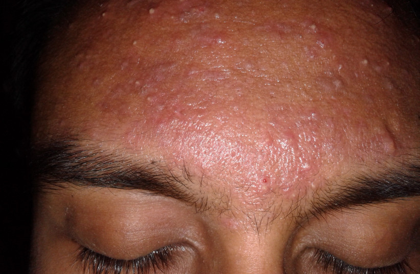  Acne is seen on a man's forehead (Illustrative). (photo credit: Wikimedia Commons)