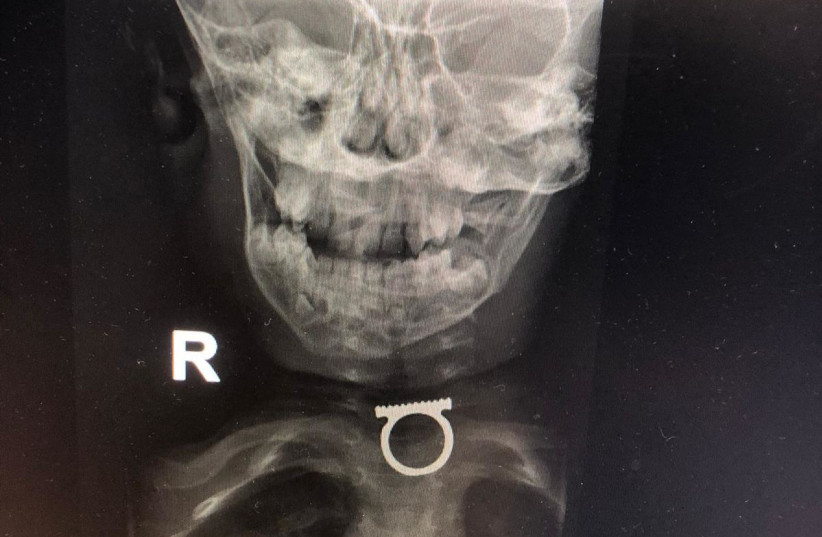  A gold ring is seen inside a child's throat at Shaare Zedek Medical Center in Jerusalem. (photo credit: Courtesy of Shaare Zedek Medical Center)