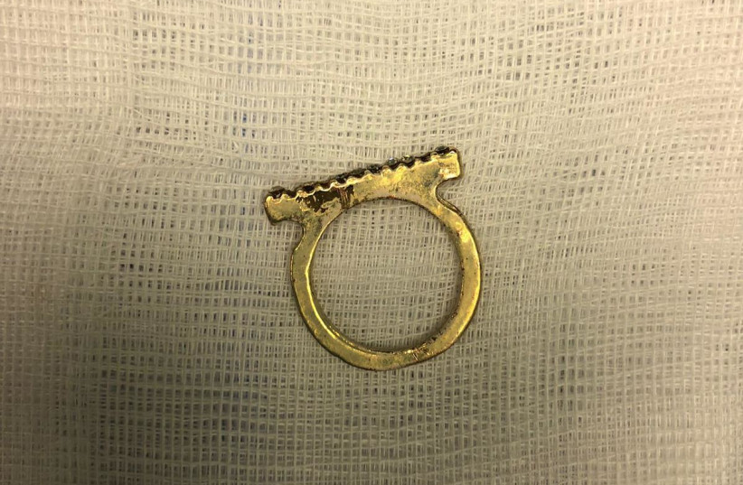  A gold ring is seen having been removed from a child's throat at Shaare Zedek Medical Center in Jerusalem. (credit: Courtesy of Shaare Zedek Medical Center)