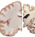 A healthy brain compared to a brain suffering from Alzheimer's Disease