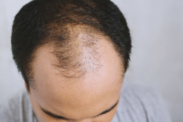 The Benefits Of Fue Hair Transplant Nyc