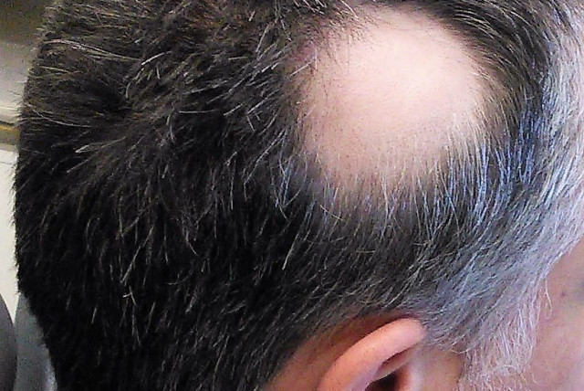 Stress hormone found to cause hair loss, new study discovers - The  Jerusalem Post