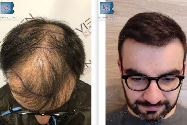 Why having a hair transplant in Turkey is better than anywhere in the wo -  The Jerusalem Post