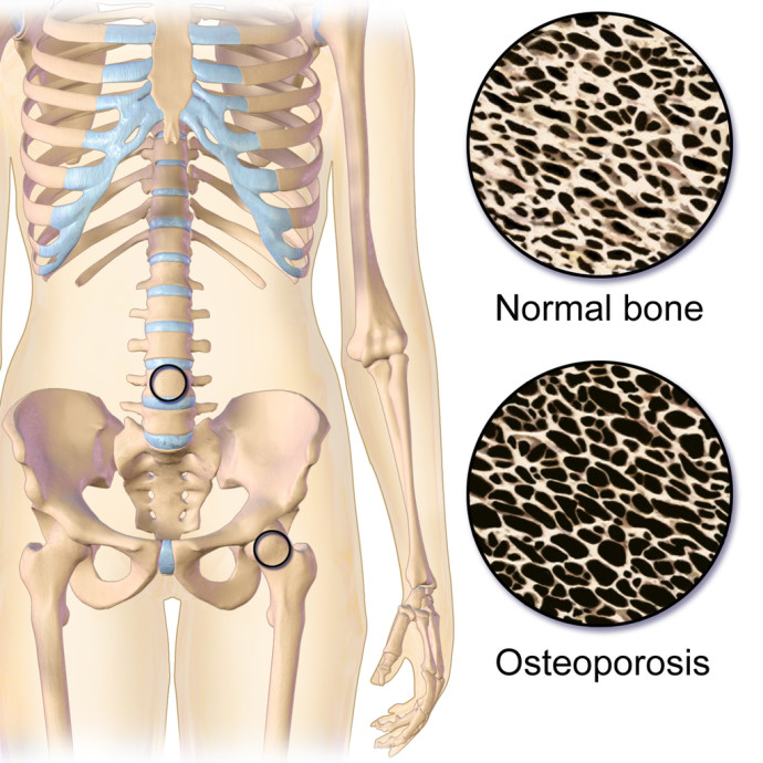 Osteoporosis Locations. Animation in the reference. Image provided by Blausen Medical CenterWikimedia Commons