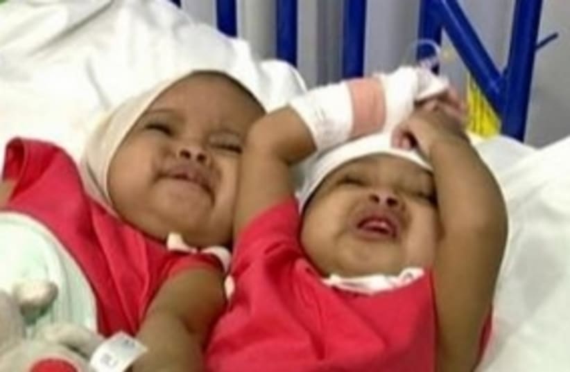 Sudanese conjoined twins (photo credit: Reuters)