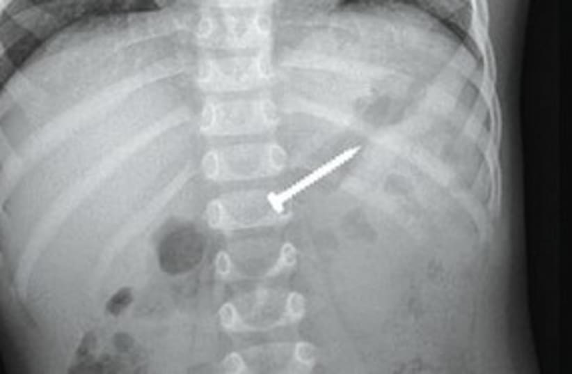 x ray of screw inside toddler's body (photo credit: Schneider Children’s Medical Center)