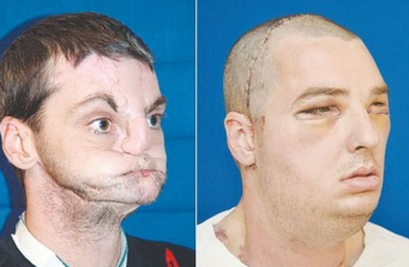 RICHARD NORRIS after surgery, and with his new face 370 (photo credit: University of Marylnd Medical Center/Reuters)
