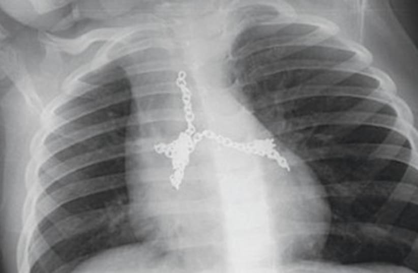 X-ray of necklace ingested by 3-year-old 390 (photo credit: Emek Medical Center)