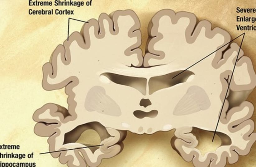 Brain with Alheimer's 521 (photo credit: Wikimedia commons)