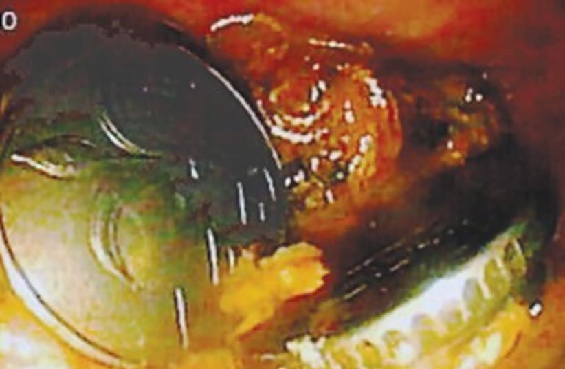 objects in a colon? 370 (photo credit: Kaplan Medical Center)