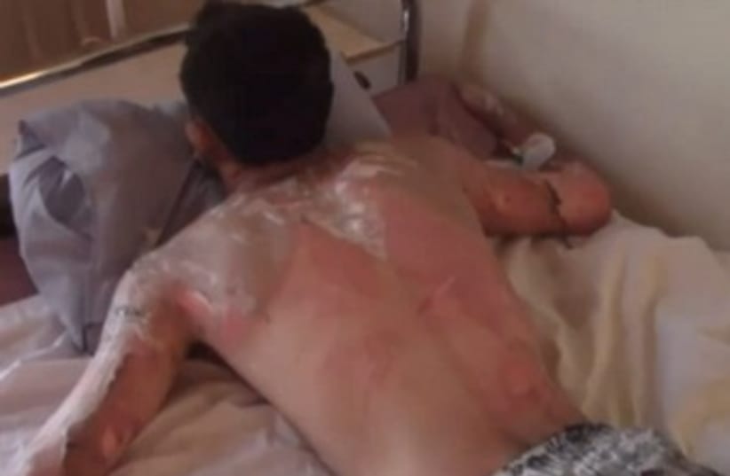 Syrian man with Napalm-like injuries 370 (photo credit: Video screenshot)