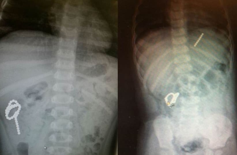Ball bearings removed from toddler and X-rays showing their movement together. (photo credit: Courtesy)