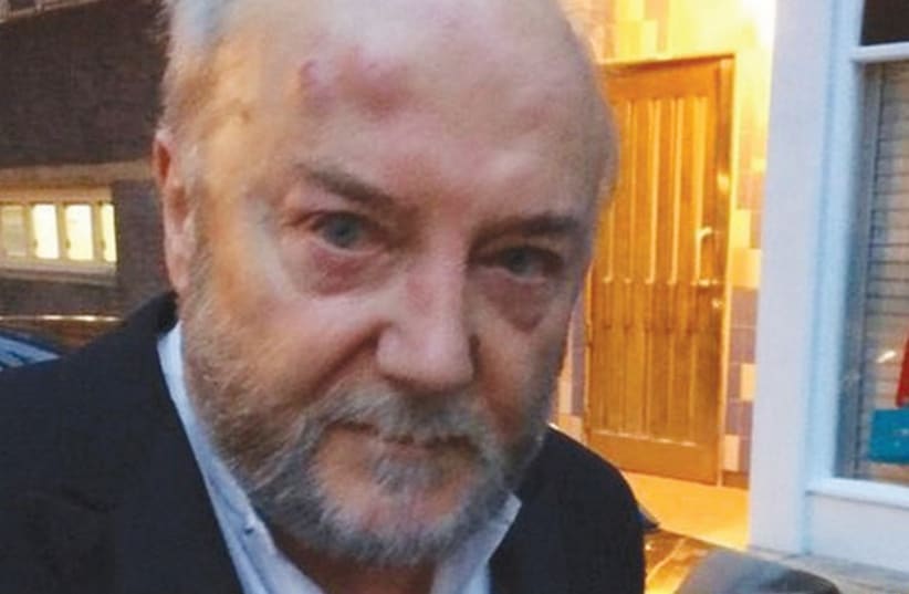 BRITISH MP George Galloway, heavily bruised, is shown after he was assaulted on a West London street on Friday (photo credit: TWITTER)