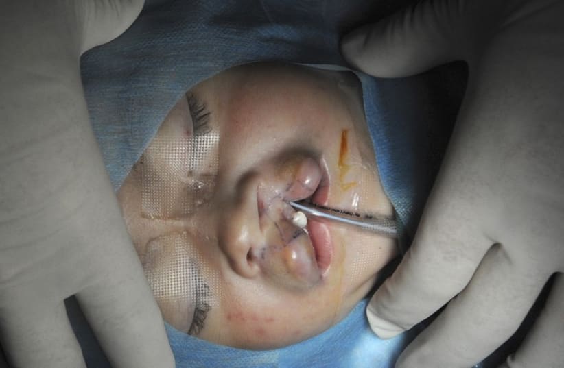 Harelip surgery on Uighur child (photo credit: REUTERS)