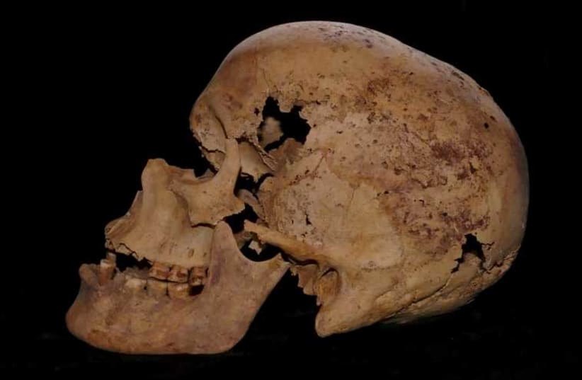 Handout of a skull, part of the skeleton of an Egyptian woman whom Egyptian authorities say shows the world's oldest evidence of breast cancer (photo credit: REUTERS)