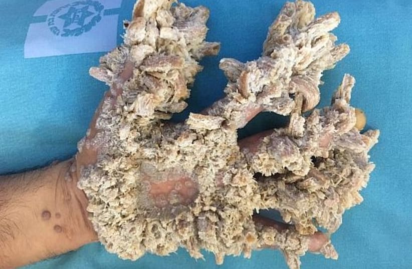 The hand of a Gaza resident who suffers from an extremely rare condition called “tree man syndrome” (photo credit: HADASSAH UNIVERSITY MEDICAL CENTER)