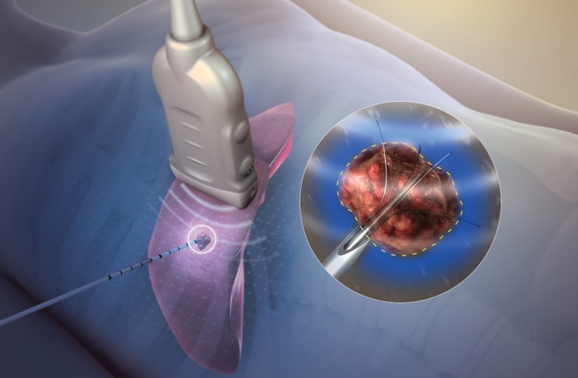 TECHSOMED'S SYSTEM removes the ‘blindfold’ in the thermal ablation cancer treatment, a minimally invasive procedure that basically ‘burns’ the cancer until it dies (photo credit: Courtesy)