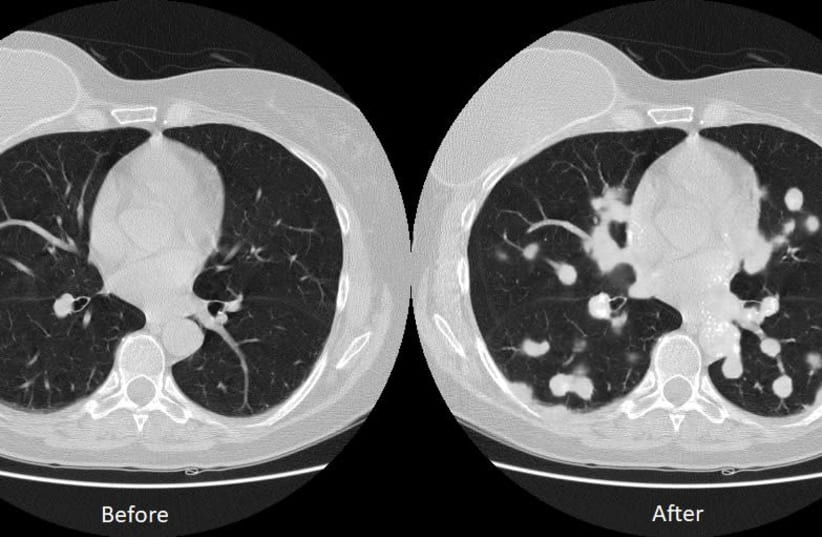 Lung cancer maliciously inserted into image in Ben-Gurion University of the Negev study (photo credit: BGU)