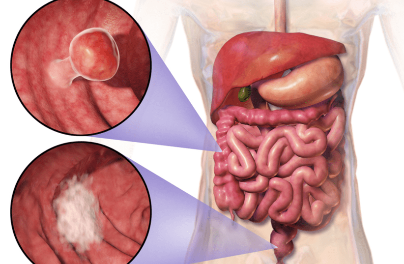 Location and appearance of two example colorectal tumors (photo credit: BLAUSEN MEDICAL COMMUNICATIONS INC./WIKIMEDIA COMMONS)