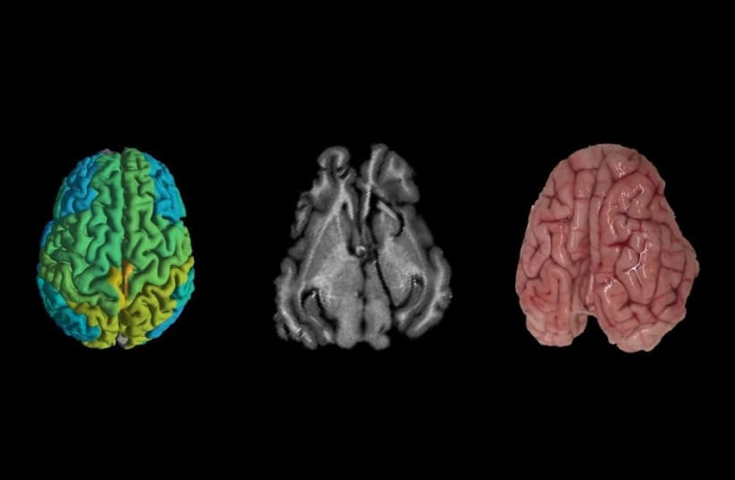 From Right to Left: Pig’s brain; standard MRI brain scan; new MRI scan showing differences in molecular makeup in different parts of the brain (photo credit: SHIR FILO/HEBREW UNIVERSITY)