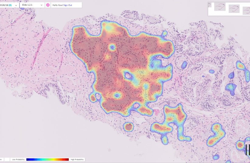  Image of the first-ever case of a misdiagnosed cancer detected by an AI solution in real time in pathology – in this case a prostate cancer that was detected by our Galen Prostate solution, on a biopsy that was previously diagnosed as benign by the pathologist. (photo credit: IBEX MEDICAL ANALYTICS)