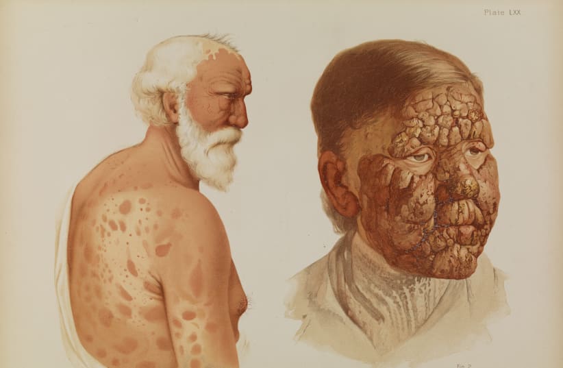 LEPROSY, PLATE LXX from Prince Albert Morrow, 1889 (photo credit: Wikimedia Commons)