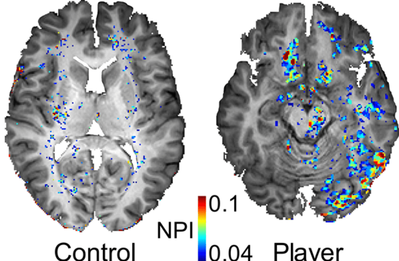 Typical brain images from a American football player (right) and a non-player control. The colored regions show brain areas with a leaky BBB. (photo credit: PROF. ALON FRIEDMAN M.D.)