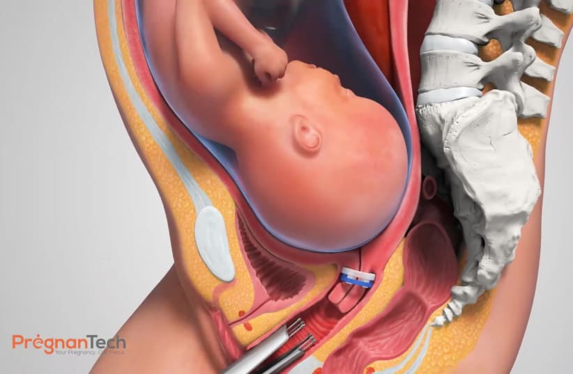 Illustrative image showing the simple installment of PregnanTech's Lioness device, developed to prevent preterm birth without invasive surgery.  (photo credit: PREGNANTECH)