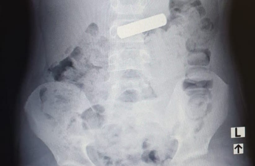 X-ray of the battery inside the seven-year-old's stomach.  (photo credit: Courtesy)