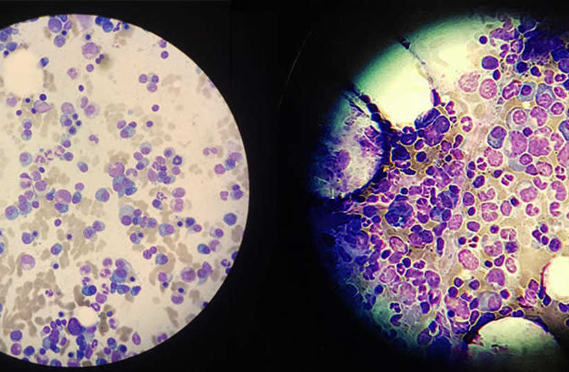 Resistant multiple myeloma cells (violet-blue) in two samples, seen under a microscope (photo credit: WEIZMANN INSTITUTE OF SCIENCE)