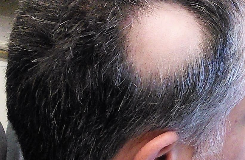 Hair loss caused by alopecia areata. (photo credit: Wikimedia Commons)
