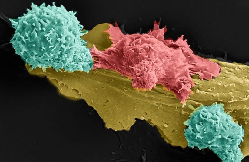 Two genetically engineered T Cells (light green) attacking a cancer cell in red. (photo credit: TILDA BARLIYA/ASTAR SHAMUL/CYRILLE COHEN)