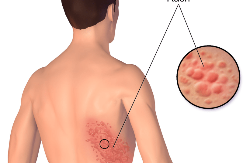 A rash from herpes zoster [Illustrative]. (photo credit: Wikimedia Commons)