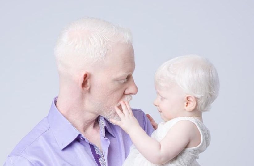 Eliran Golan, CEO and one of the founders of Albi, Israel’s first albinism association, with his 10-month-old daughter, Ariel (photo credit: Courtesy)
