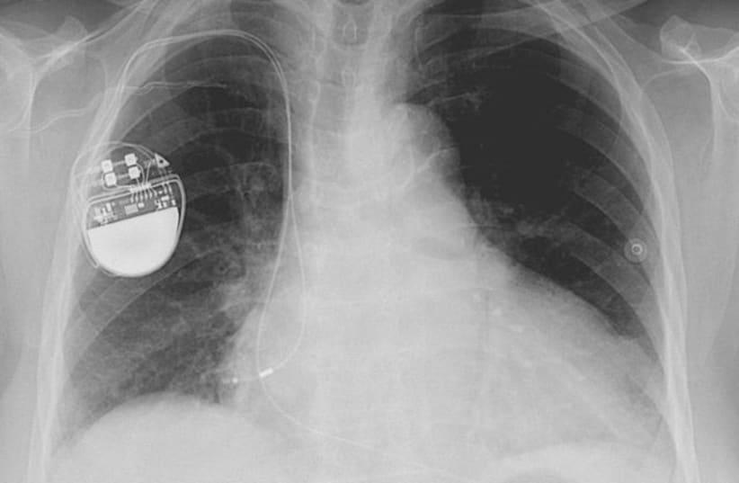 The batteries in medical devices such as pacemakers could soon be replaced by energy generated through the wearer's own body movements. (photo credit: Wikimedia Commons)