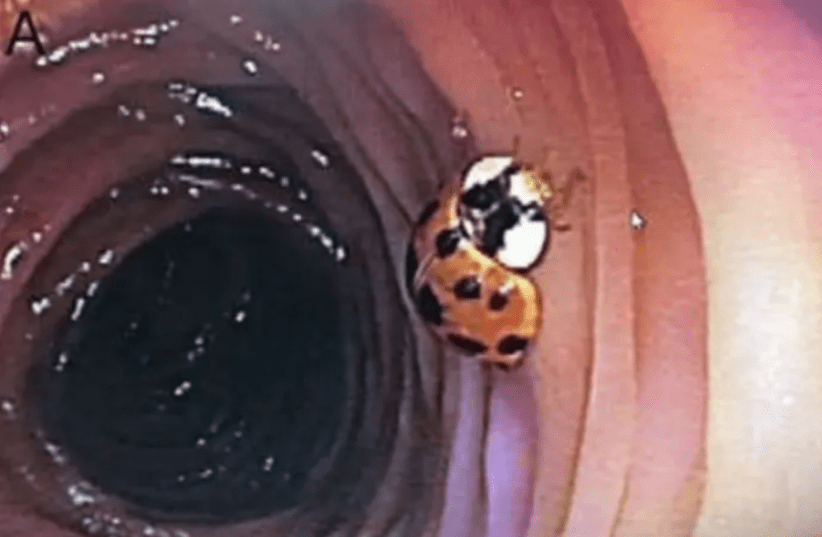  The ladybug living inside the man's colon. (photo credit: American College of Gatroenterology)