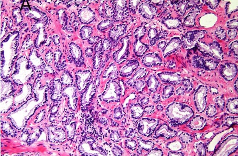  Micrograph of prostate cancer with Gleason score 6 (3+3) (photo credit: Diagnostic Pathology 11/Jennifer Gordetsky and Jonathan Epstein)